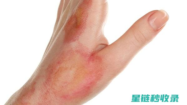 轻微烫伤：急救处理的正确步骤 (轻微烫伤急救)